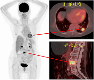 『正子檢查在腫瘤』的應用(相關圖片)