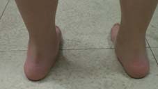 鴨母腳蹄  談『兒童扁平足』(相關圖片)