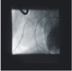 『左、右大不同』淺談「右心發育不全症」及「混合性開心手術」(相關圖片)