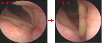 『嗓音障礙』的治療新趨勢(相關圖片)