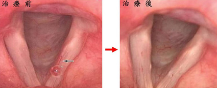『嗓音障礙』的治療新趨勢(相關圖片)