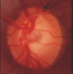 眼壓高就是『青光眼』？(相關圖片)