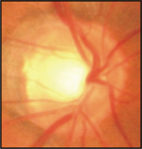 眼壓高就是『青光眼』？(相關圖片)