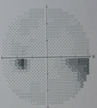 眼壓高就是『青光眼』？(相關圖片)