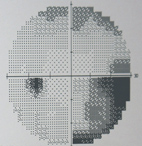 眼壓高就是『青光眼』？(相關圖片)