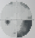 眼壓高就是『青光眼』？(相關圖片)