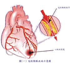 秋冬季節『冠狀動脈疾病』的預防與治療(相關圖片)