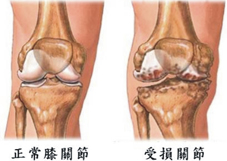 天冷了  『膝關節疼痛』如何保養(相關圖片)