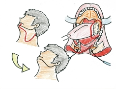 『經口達文西腫瘤切除』手術(相關圖片)