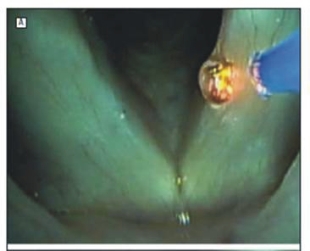 脈衝式『綠光雷射』(相關圖片)