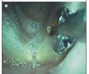 脈衝式『綠光雷射』(相關圖片)