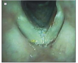 脈衝式『綠光雷射』(相關圖片)