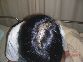 『微創神經外科手術』的介紹(相關圖片)