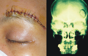 『微創神經外科手術』的介紹(相關圖片)