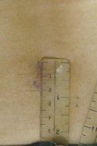 『微創神經外科手術』的介紹(相關圖片)