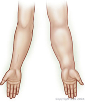 『前哨淋巴結攝影』治療早期乳癌分期更精確  併發症更減少(相關圖片)