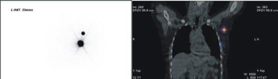 『前哨淋巴結攝影』治療早期乳癌分期更精確  併發症更減少(相關圖片)