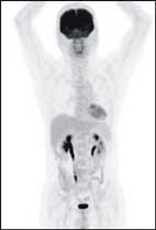 『正子斷層掃描』在健康檢查所扮演的角色(相關圖片)