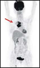 『正子斷層掃描』在健康檢查所扮演的角色(相關圖片)