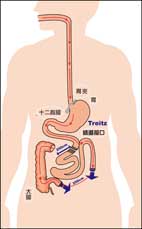 談『微創代謝手術-別讓親人掛太早(相關圖片)