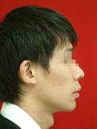 『齒顎矯正』  讓美觀更有自信(相關圖片)