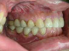 『齒顎矯正』  讓美觀更有自信(相關圖片)