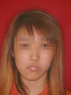 『齒顎矯正』  讓美觀更有自信(相關圖片)