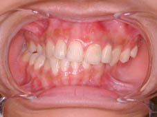 『齒顎矯正』  讓美觀更有自信(相關圖片)