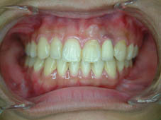 『齒顎矯正』  讓美觀更有自信(相關圖片)