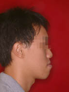 『齒顎矯正』  讓美觀更有自信(相關圖片)