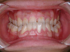 『齒顎矯正』  讓美觀更有自信(相關圖片)