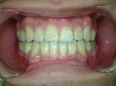 『齒顎矯正』  讓美觀更有自信(相關圖片)