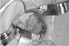 口腔黏膜缺損重建    『冷凍乾燥異體肌膜』(相關圖片)