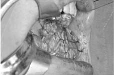 口腔黏膜缺損重建    『冷凍乾燥異體肌膜』(相關圖片)