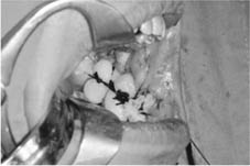 口腔黏膜缺損重建    『冷凍乾燥異體肌膜』(相關圖片)