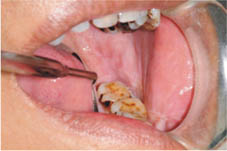 口腔黏膜缺損重建    『冷凍乾燥異體肌膜』(相關圖片)