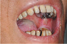 口腔黏膜缺損重建    『冷凍乾燥異體肌膜』(相關圖片)