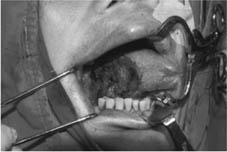 口腔黏膜缺損重建    『冷凍乾燥異體肌膜』(相關圖片)