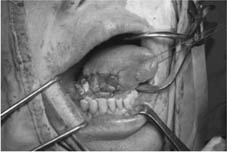 口腔黏膜缺損重建    『冷凍乾燥異體肌膜』(相關圖片)