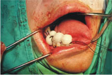 口腔黏膜缺損重建    『冷凍乾燥異體肌膜』(相關圖片)