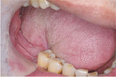 口腔黏膜缺損重建    『冷凍乾燥異體肌膜』(相關圖片)