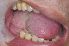 口腔黏膜缺損重建    『冷凍乾燥異體肌膜』(相關圖片)