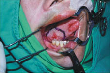 口腔黏膜缺損重建    『冷凍乾燥異體肌膜』(相關圖片)