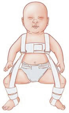 瞭解新生兒髖關節不全(相關圖片)