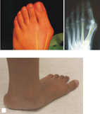 瞭解新生兒髖關節不全(相關圖片)