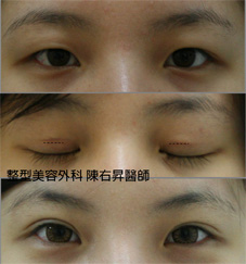 微小切口雙眼皮成形術(相關圖片)