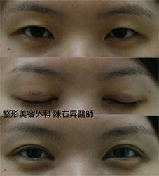 微小切口雙眼皮成形術(相關圖片)