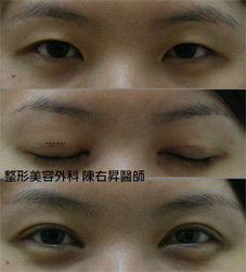 微小切口雙眼皮成形術(相關圖片)