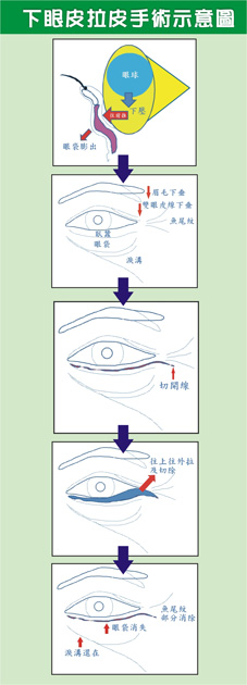 是臥蠶？還是眼袋？ 讓專業醫師告訴您！(相關圖片)