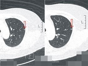 防微杜漸   談肺癌篩檢(相關圖片)